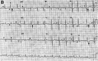 实拍女子做心电图视频,女子心电图实拍,揭秘心脏健康检测过程